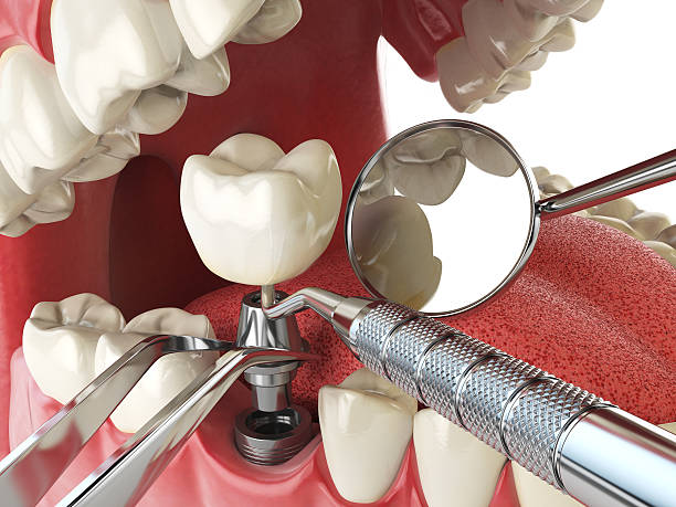 Best Emergency Root Canal Treatment in West Mountain, UT